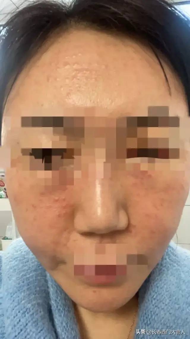 女子自学打水光针脸上长出硬疙瘩